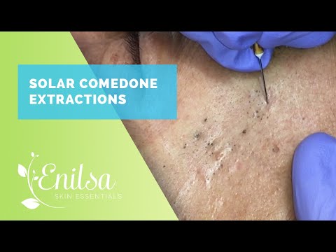 Solar Comedone Extractions