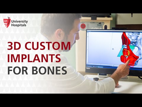 Why Are 3D Custom Implants Used for Bone Cancer Patients?