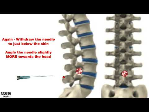 "Walking the needle in" on Lumbar Puncture