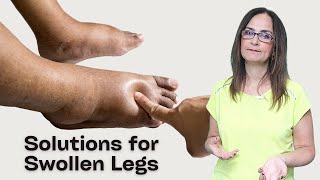 #165 Combat leg swelling naturally: Effective exercises and compression stocking solutions