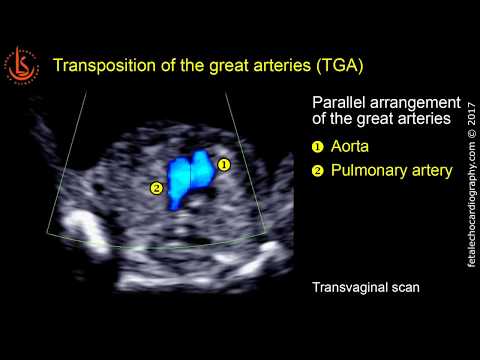 Fetal echocardiography at 11-13 weeks: Transposition of the Great Arteries (TGA)