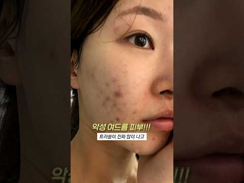 악성 여드름 피부가 찐 효과본 흉터연고..!! 7년째추천하는데 진짜 좋음ㅣ아랑