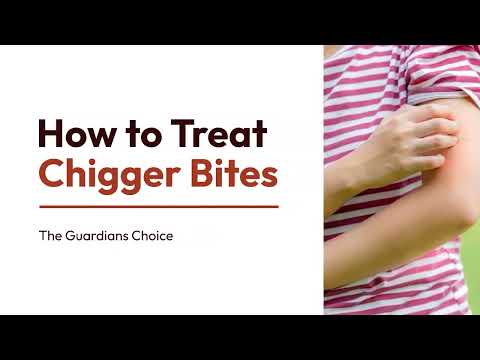 How to Identify & Treat Chigger Bites | 3 Ways to Treat Chigger Bites | The Guardians Choice