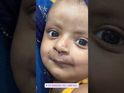 Best cleft lip repair