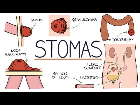 Understanding Stomas (Colostomy, Ileostomy, Urostomy and Gastrostomy)