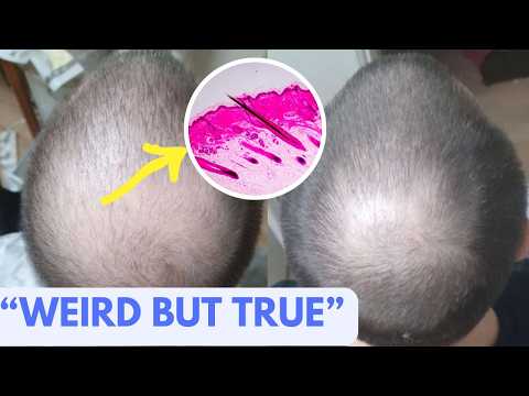 Hair Loss & Blood Flow -TRUTH or MYTH?