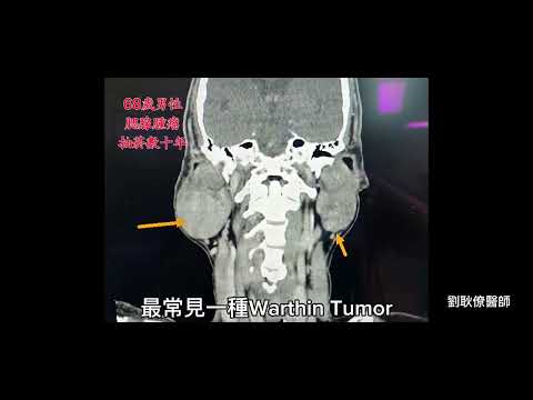 腮腺腫瘤 Parotid Tumor 顏面神經 Facial Nerve