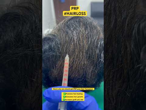 #hair #hairlosstreatment #alopecia #balding #hairtransplant #ytshorts #prp #shorts