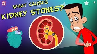 What Causes Kidney Stones? | The Dr. Binocs Show | Best Learning Videos For Kids | Peekaboo Kidz