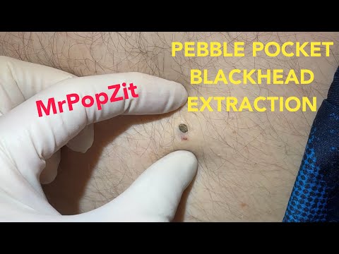 Large pebble blackhead pocket on thigh extracted and sac lining inner pocket removed and sutured