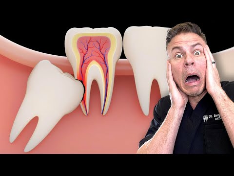 Is Removing Your Wisdom Teeth BAD For You?!