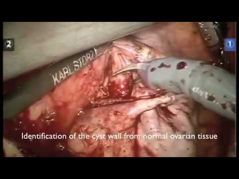 Ovarian Cystectomy in Endometriosis Robotic Vs Laaproscopy Rooma Sinha, Apollo Hyderabad