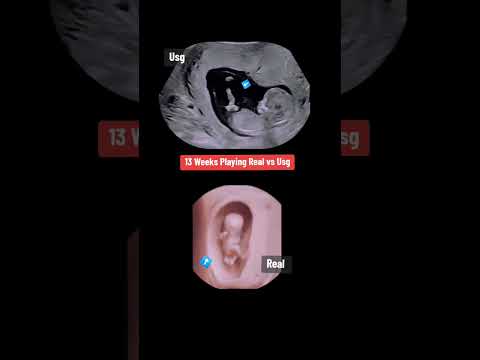 13 weeks baby playing inside Womb #babyultrasound #baby #ultrasound #pregnancyscan