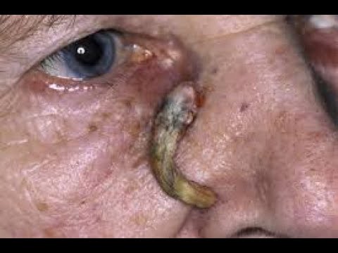 Blackhead Removal new Videos 2021- Ear Blackheads Removal | Best  pimple popper new videos 2021