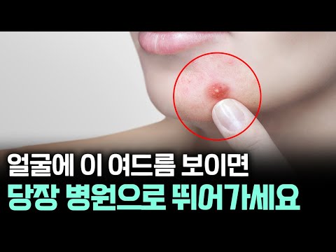 이 여드름 보이는 순간 신발부터 신으세요... 🤔 압출은 이 타이밍 놓치면 흉터 남습니다