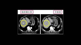 肝臓癌 Dynamic CT #Shorts