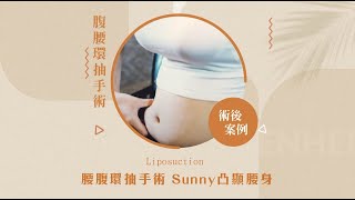 抽脂｜腰腹環抽手術 Sunny凸顯腰身，胸臀曲線自然大又翹！抽脂過程