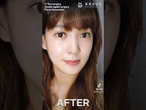 Plastic surgery before and after🤩