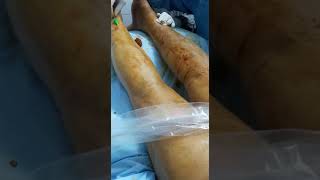 Endovenous Laser Ablation of the Vein of Giacomini