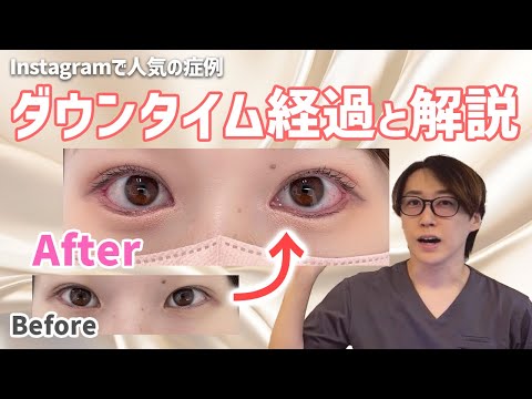 つり目が大きい目に！激変する過程を医師が解説【たれ目形成】