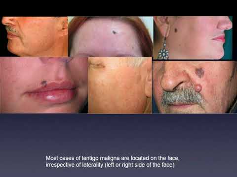 Clinical clues for location-lentigo maligna -  Dr. Danica Tiodorovic