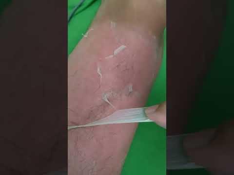 sunburn peeling曬傷脫皮