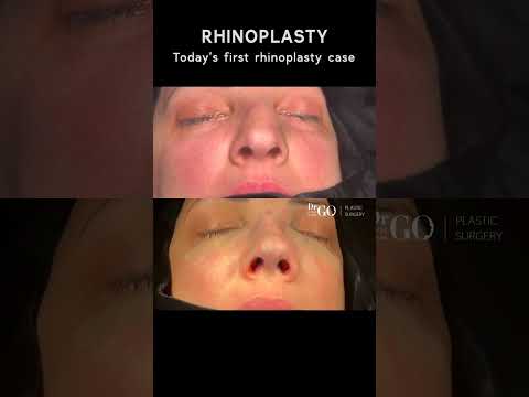 Patient Journey: Rhinoplasty Transformation 🌟