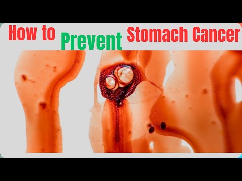 Causes Of Stomach Cancer And How To Prevent Stomach Cancer