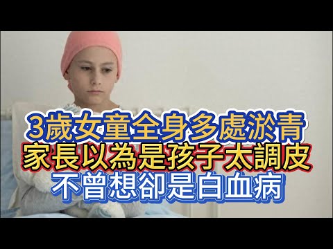 3歲女童全身多處淤青，家長以為是孩子太調皮，不曾想卻是白血病