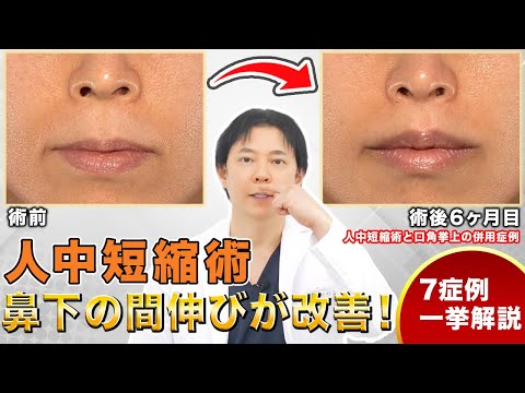 人中短縮術で口元の印象が若返る！症例写真を一挙解説【美容医療】