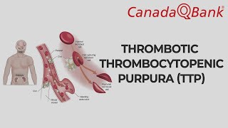 Thrombotic Thrombocytopenic Purpura (TTP)