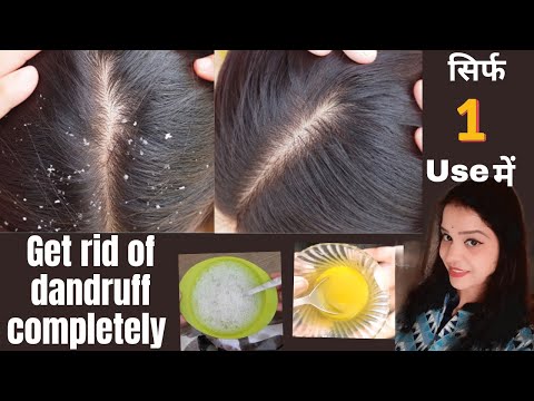 how to treat dandruff naturally at home permanently सर्दियों में ऋषि से पूरी तरह से छुटकारा पाएं।