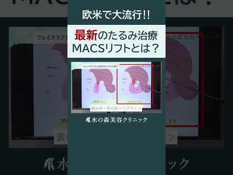 【最新のたるみ治療】MACSリフトをご紹介！#shorts #水の森美容クリニック #美容整形 #美容 #水の森美容外科