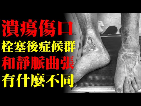 慢性潰瘍傷口，栓塞後症候群和靜脈曲張有什麼不同？｜許原彰醫師：台北，台中，高雄，台南，新竹，靜脈曲張專家