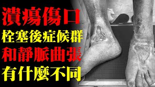 慢性潰瘍傷口，栓塞後症候群和靜脈曲張有什麼不同？｜許原彰醫師：台北，台中，高雄，台南，新竹，靜脈曲張專家