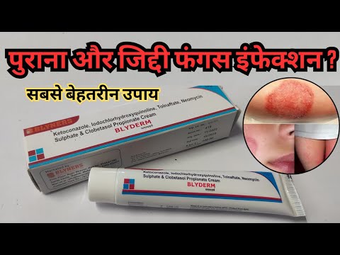 कितना भी पुराना और जिद्दी फंगस इंफेक्शन क्यों ना हो मिटेगा तुरंत Blyderm Cream