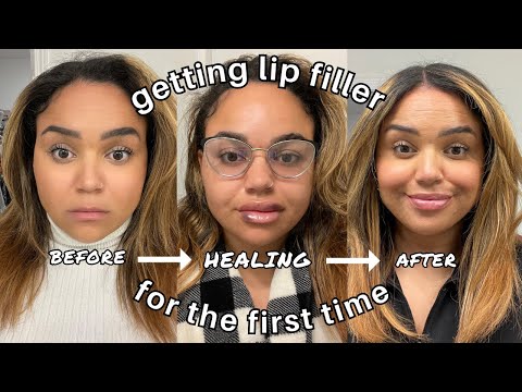 LIP FILLER VLOG *my FIRST time* // The appointment, FULL healing process + my overall experience