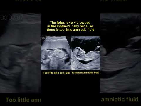 baby crowded inside Womb during ultrasound scan little amniotic fluid