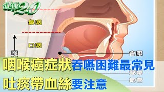 咽喉癌症狀吞嚥困難最常見 吐痰帶血絲要注意 健康2.0