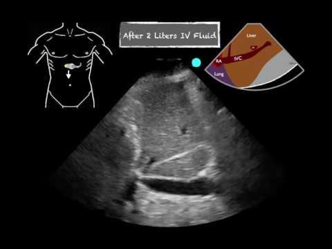 POCUS Cardiac IVC Change with fluids