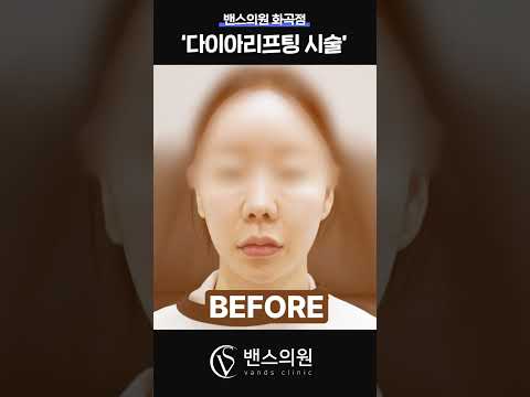 [밴스의원 강서화곡점]리프팅은 하고 싶은데 통증 때문에 망설이신다면?🫣 포텐자 다이아 리프팅을 소개해요📢