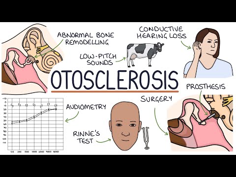 Understanding Otosclerosis