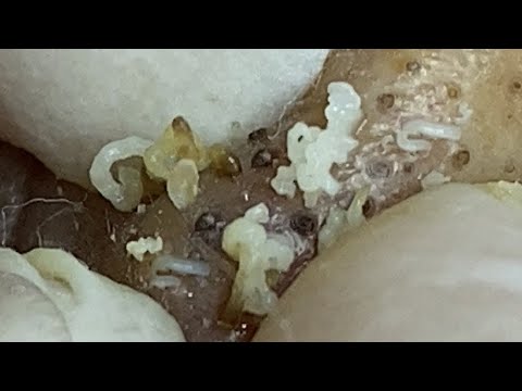 huge blackheads on face