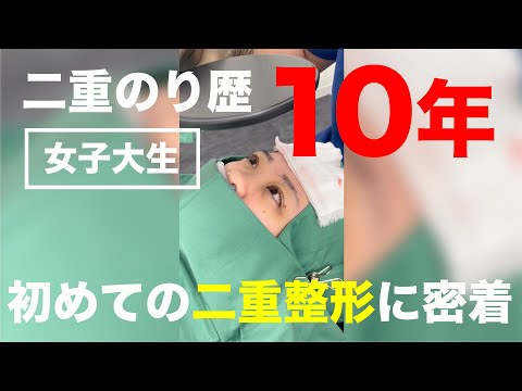 【二重のり歴10年以上】女子大生の初めての二重整形に密着❗️