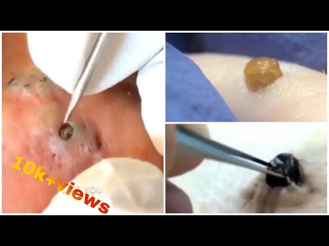 (7 Intense Blackhead Removal videos) | Poppy TV Ep#2 | viral video compilation