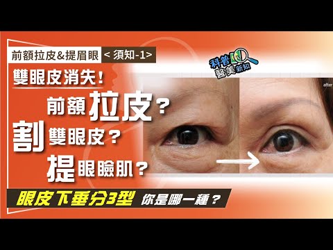 前額拉皮&提眉眼（須知-1）雙眼皮消失原因「有這些」...眼皮下垂有3類型 你是哪一種？　上額拉皮/割雙眼皮/提眼瞼肌 選哪一個才對？ 科普醫美新知368-20241129