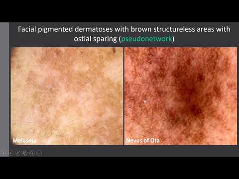 Dermoscopy of Skin of Colour - Dr Enzo ERRICHETTI