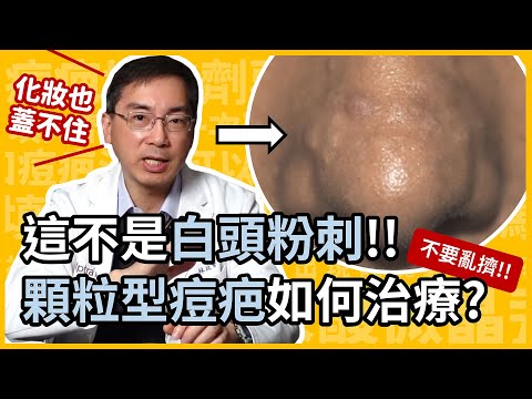 這不是白頭粉刺！鼻子和下巴的丘疹型痘疤，該如何治療呢？皮膚科林政賢醫師教你除掉這種化妝也遮不住的顆粒型痘疤！