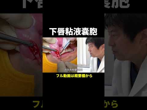 【Japanese Dental Clinic】Lower lip Mucous retention cyst or mucocoele removal as daycare surgery