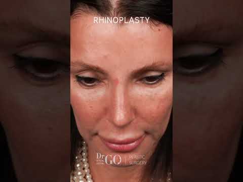 Rhinoplasty Transformation by Assoc. Prof. Dr. Güncel Öztürk | Before & After Results